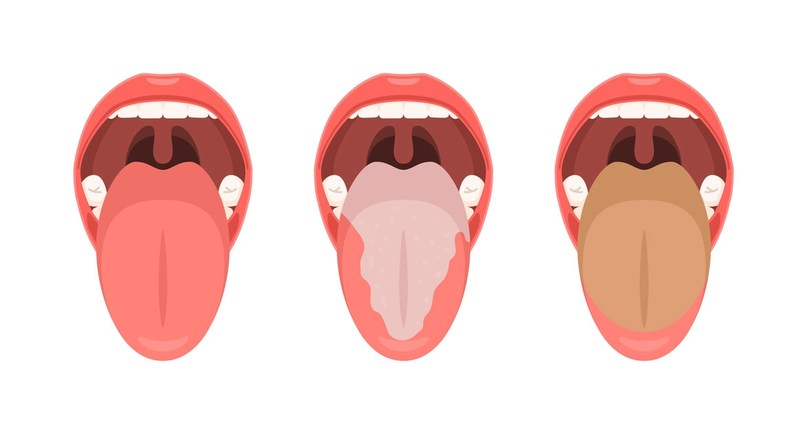 Чому змінюється колір язика та що з цим робити