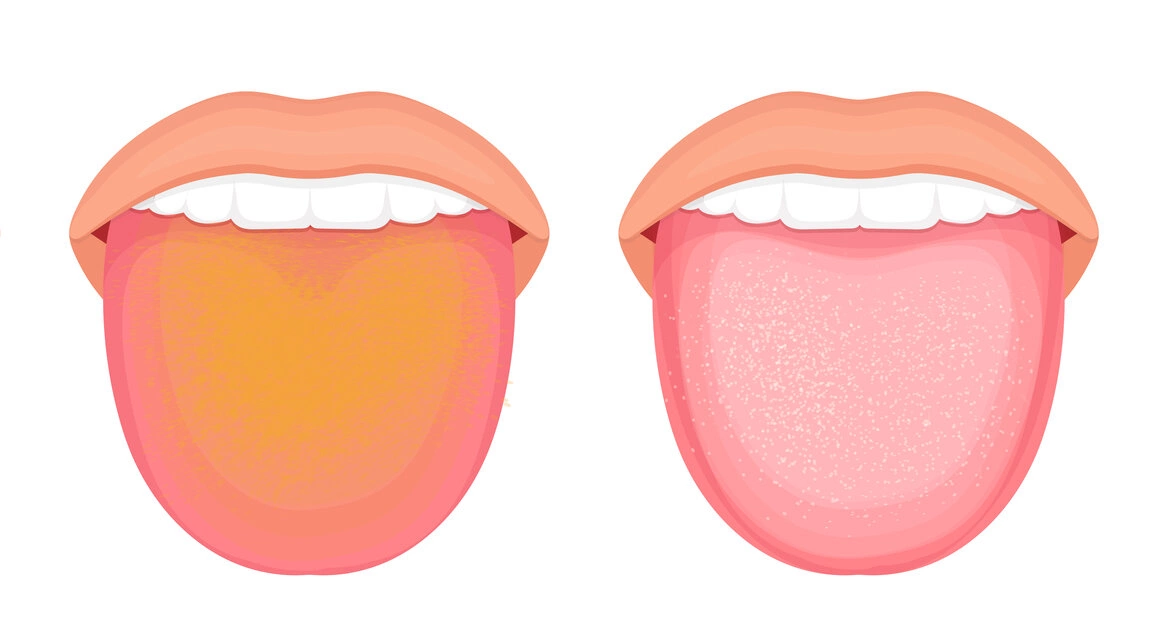 Чому на язику утворюється наліт та як його позбутися