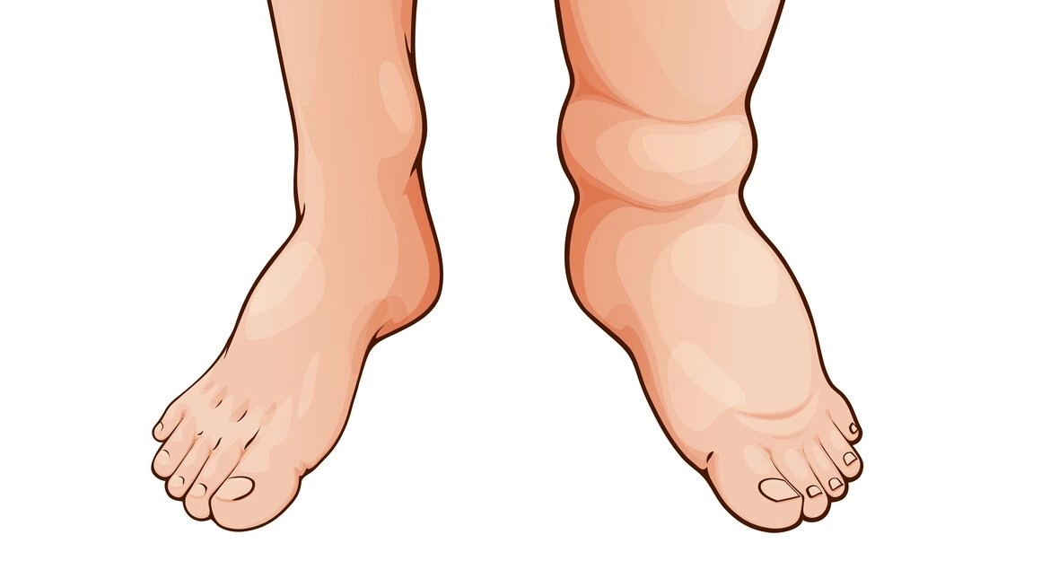 Отечность ног: причины и современные методы лечения отека ног