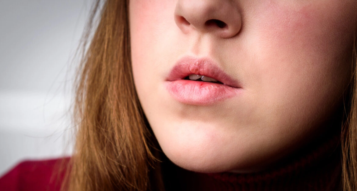 Как вылечить потрескавшиеся губы. | Статьи Ceramed