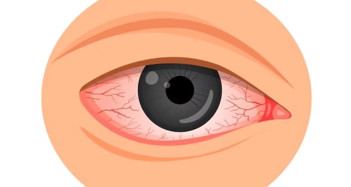 Покраснение глаз — что это? Причины и как лечить красные глаза