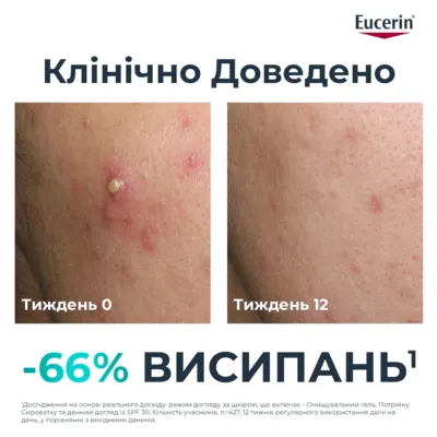 Юцерин (Eucerin) ДермоПьюр сироватка потрійної дії для проблемної шкіри обличчя 40 мл — Фото 9
