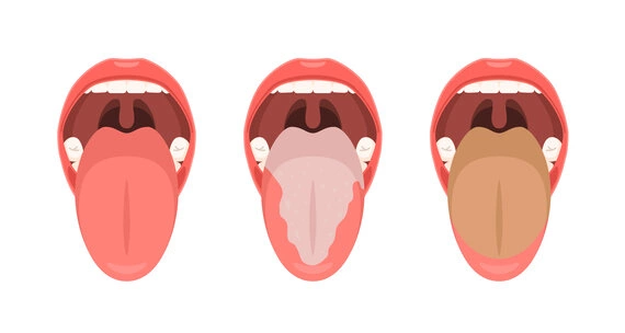 Чому змінюється колір язика та що з цим робити