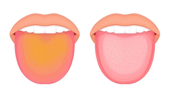 Чому на язику утворюється наліт та як його позбутися