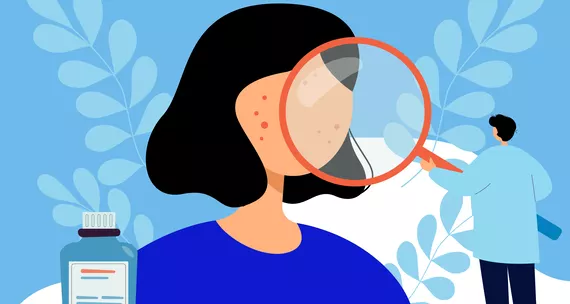 Как лечить демодекоз и избавиться от него навсегда?