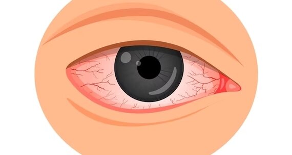 Покраснение глаз: причины, последствия, лечение и профилактика