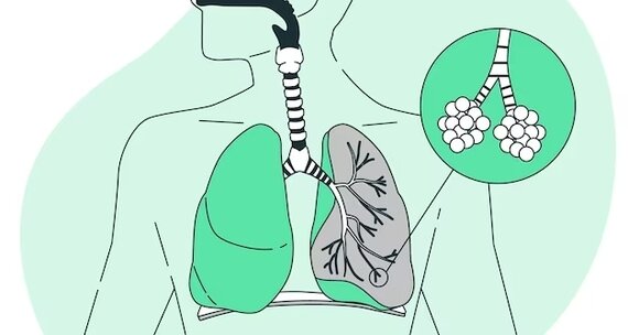 Бронхиальная астма: что это, причины, симптомы, лечение и профилактика
