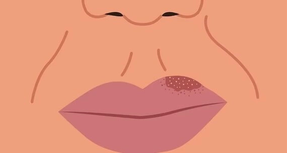 Герпес на губі: причини виникнення та методи лікування