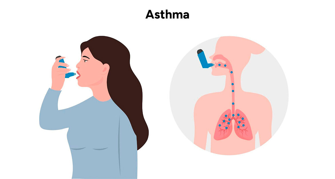 Симптомы обострения астмы