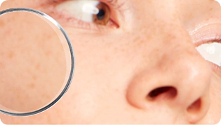 Аллергичная и раздражённая кожа