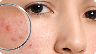 Проблемная кожа